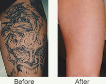 tattoo removal